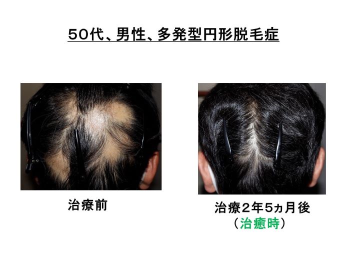 円形脱毛症　病院